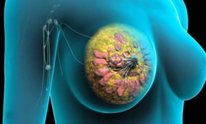 تصویر شماتیک از بافت سینه شامل غدد، مجاری شیری و کیست فیبروکیستیک