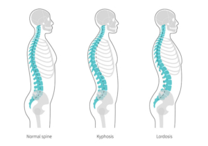 مقایسه انحنای طبیعی ستون فقرات با کیفوز و لوردوز