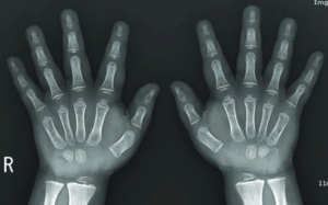 عکس رادیولوژی از هر دو دست برای ارزیابی سن استخوان در کودکان