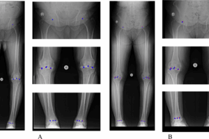 پیشگامی مرکز تصویربرداری راد در تشخیص ناهنجاریهای اندام تحتانی با هوش مصنوعی