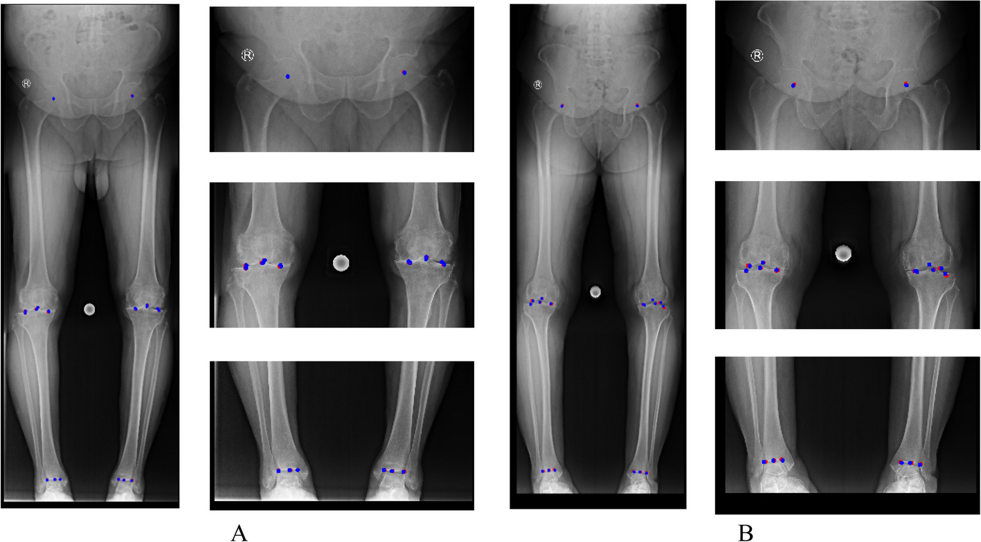 پیشگامی مرکز تصویربرداری راد در تشخیص ناهنجاریهای اندام تحتانی با هوش مصنوعی