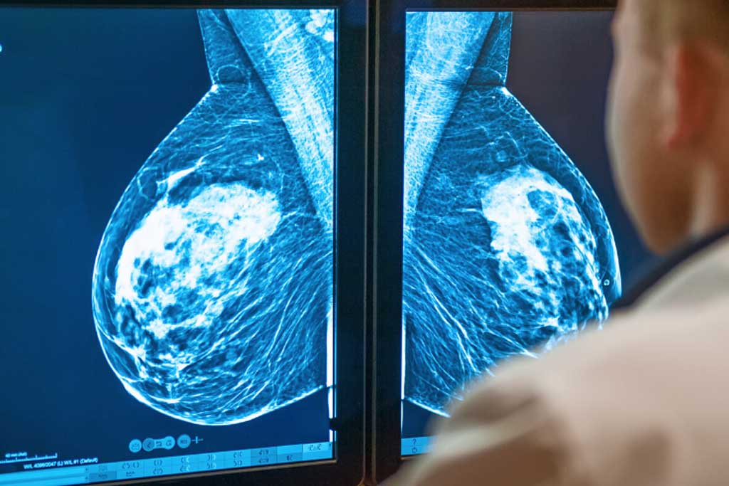 ماموگرافی سینه و زیربغل: راهنمای کامل غربالگری، مراحل، تفسیر نتایج و نقش سونوگرافی