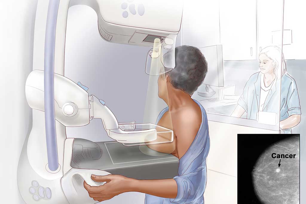 مراحل انجام ماموگرافی