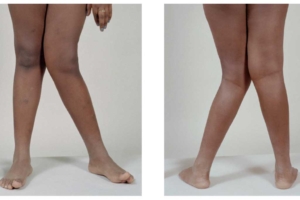 رادیوگرافی Alignment View: بررسی همراستایی اندام تحتانی