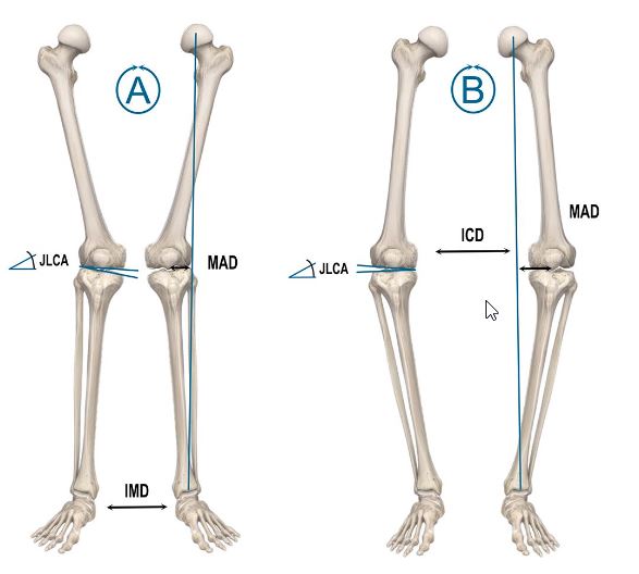 محور مکانیکی والوگوس (Knock Knee)