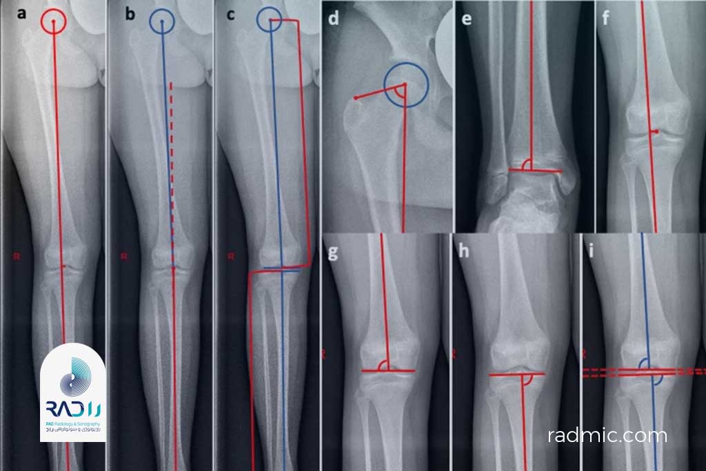 رادیوگرافی اندام تحتانی