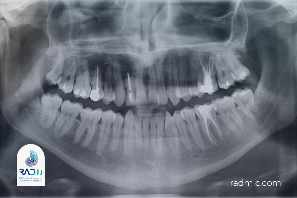عکس OPG دندان یا Orthopantomogram