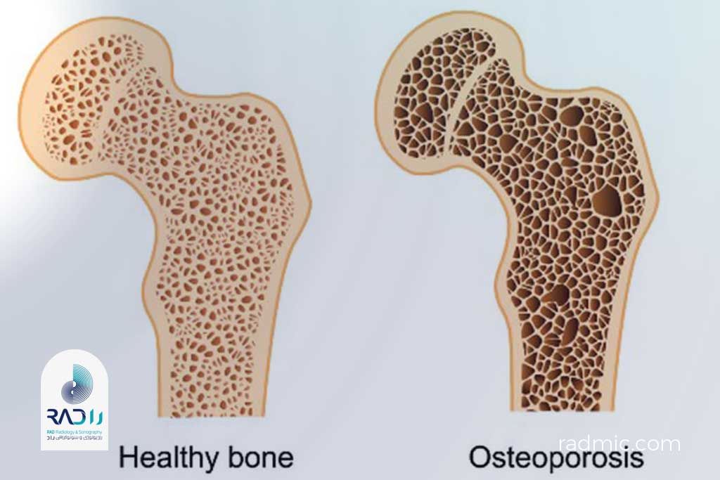 تراکم استخوان یعنی چه؟
