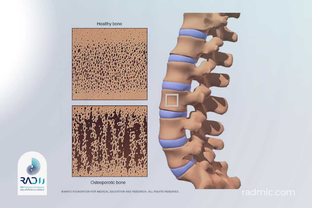 پوکی استخوان دقیقاً چیست؟