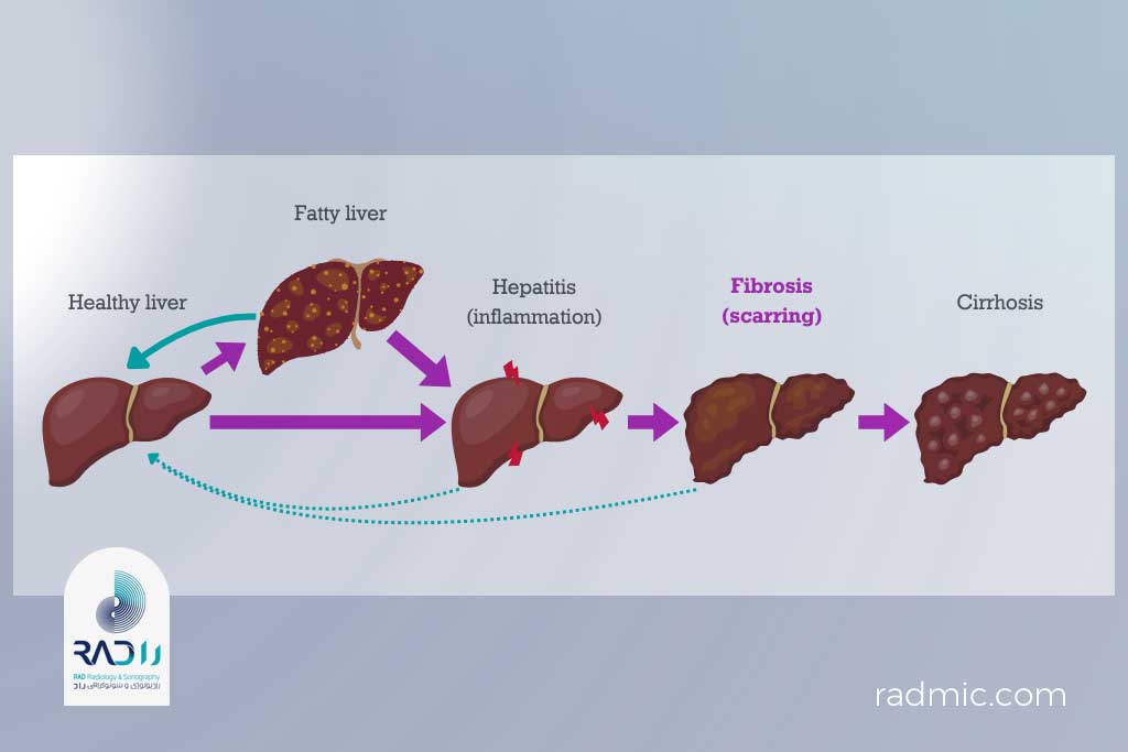 چه چیزی باعث ایجاد فیبروز کبد میشود؟