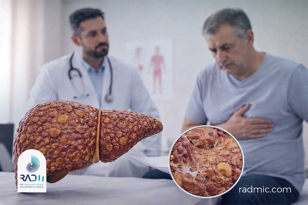 سیروز کبد چیست؟