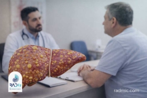 بیماری کبد چرب