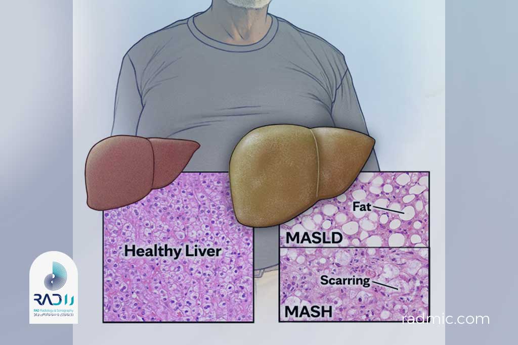 در مقایسه با کبد سالم، کبد چرب بزرگتر و تغییر رنگ داده به نظر میرسد.