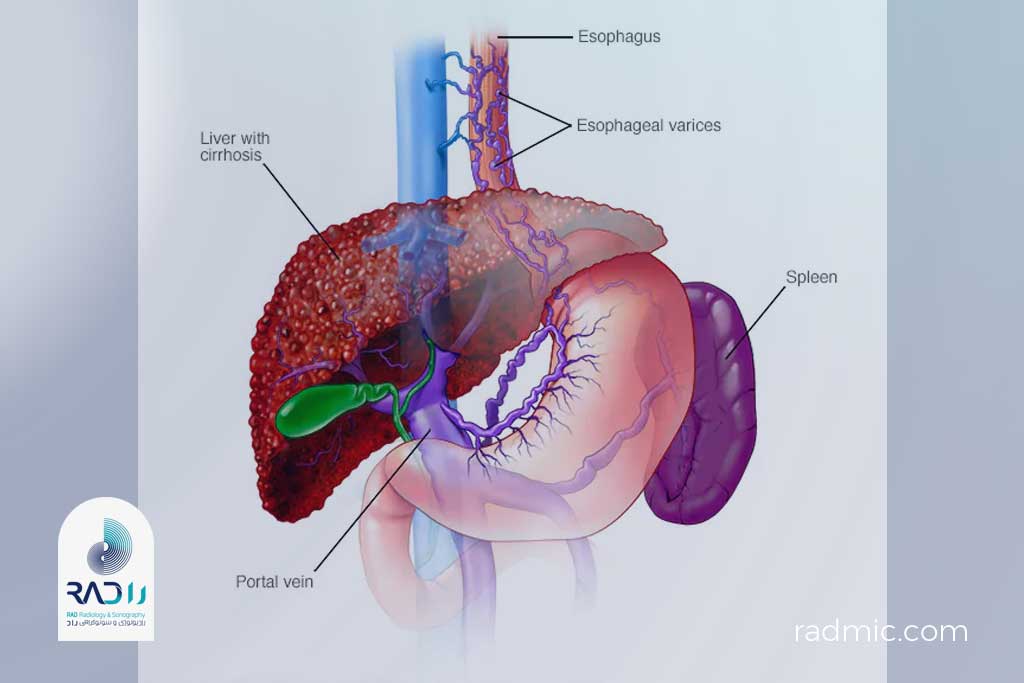 سیروز کبدی و واریس مری