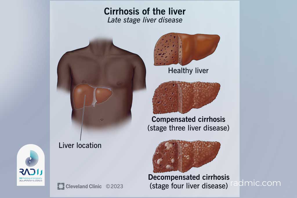 آیا سیروز مرحله‌بندی دارد؟